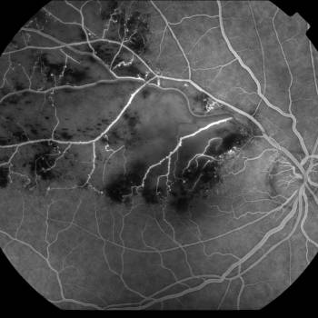 eye before laser treatment branch retinal vein occlusion right eye 